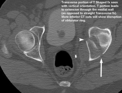 Acetabular Fractures - Trauma - Orthobullets